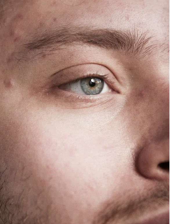 Close-up of acne-prone skin and blemishes showing real results with Skinity skincare.